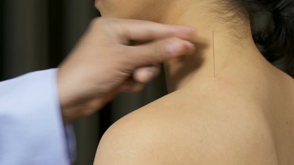 young woman undergoing acupuncture treatment on shoulder
