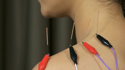 young woman undergoing acupuncture treatment with electrical stimulator on shoulder
