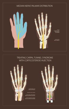 Carpal Tunnel Syndrome, Treating With Corticosteroid Injection