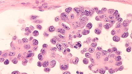 Ovarian Cancer Awareness: Micrograph of a serous papillary carcinoma (adenocarcinoma) of ovary,...