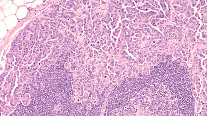 Photomicrograph of ovarian cancer (serous papillary carcinoma), metastatic to a pelvic lymph node. 