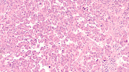 Ovarian Cancer Awareness: Micrograph of a serous papillary carcinoma (adenocarcinoma) of ovary,...
