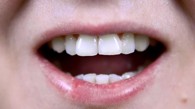Young woman shows crooked teeth. The woman opened her mouth. Close-up.