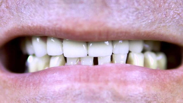 Old man shows teeth. The upper teeth are straight and the lower crooked. close-up