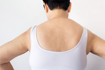 Senior asian with freckles on her back,Close up,Healthy skin problem concept