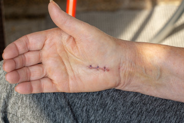 hands of senior woman with a scar of a fresh carpal tunnel syndrome  surgery