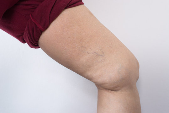 Varicose Veins On Elderly Asian Woman Leg,Close Up