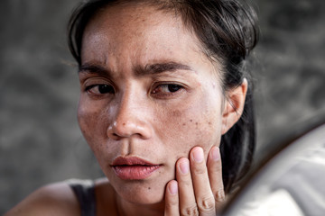 sad Asian woman having skin problem checking her face with dark spot, freckle from uv light in...