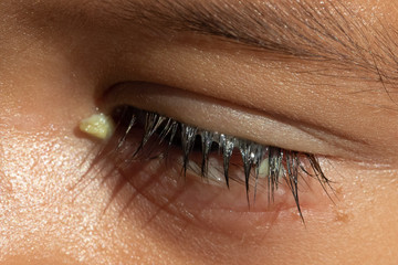 A macro view on the eye of a preschool boy, with red and puffy lower eyelid, yellow crusty...