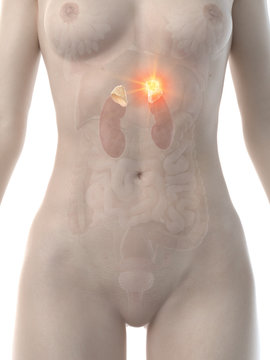 3d rendered medically accurate illustration of a womans adrenal glands cancer