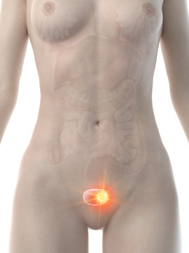 3d rendered medically accurate illustration of a womans urinary bladder cancer