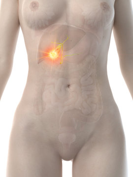 3d rendered medically accurate illustration of a womans gallbladder cancer