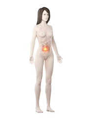 Fototapeta premium 3d rendered medically accurate illustration of a womans small intestine cancer