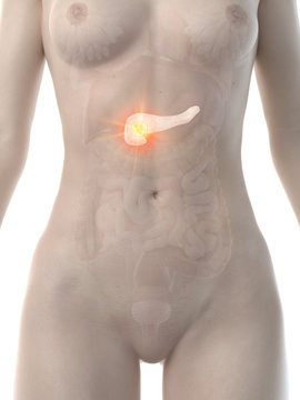 3d rendered medically accurate illustration of a womans pancreas cancer