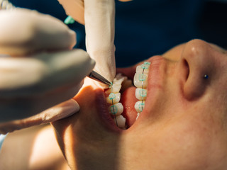 process of placing white dental braces to a Caucasian girl in a dental clinic with a dentist girl