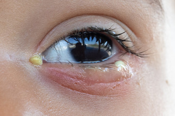 A close up and front view on the eye of a preschool child suffering from bacterial conjunctivitis,...