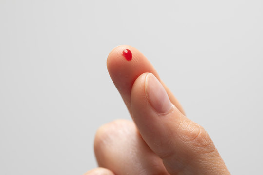 Hypoglycemia prevention as a diabetic person is seen closeup with pierced finger, small drop of blood on fingertip to monitor and analyze sugar levels in the body.