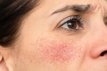 A frowning caucasian woman is seen close up and from the side, upset with a severe case of rosacea, causing red blotchy cheeks, resulting in depression and anxiety.
