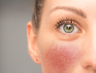 A closeup view on the eye and cheek of a young woman suffering from red blotchy cheeks, blushing...