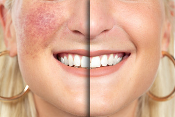 A side by side comparison of successful intense pulsed light (IPL) treatment for rosacea, dilated...