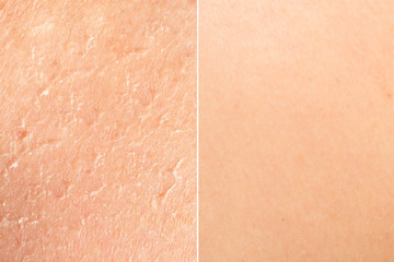 A side by side comparison of human skin showing scarring and blemishes against blurred flawless youthful skin, before and after dermatologist treatment.