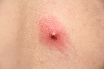 large inflamed pimple on human skin, medical concept, close-up, copy space