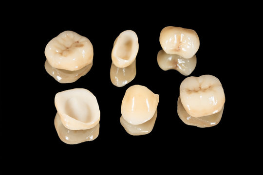 ceramic crowns of human teeth closeup macro isolate on a black background. The concept of aesthetic dentistry