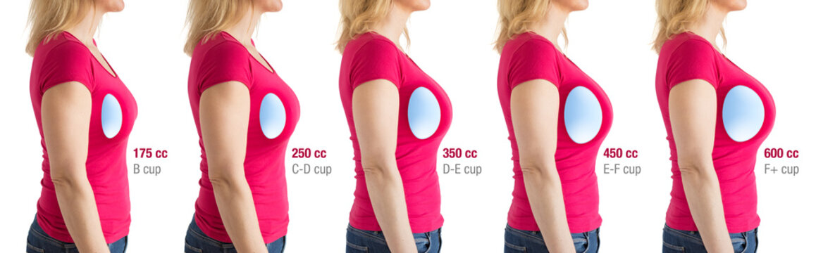 How to choose breast implants. Different types and sizes of breast implants for different results.