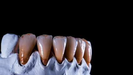 natural look ceramic veneers photoes