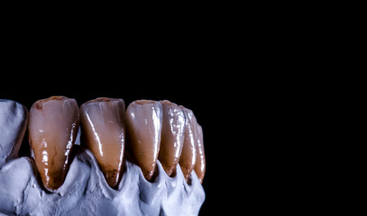 natural look ceramic veneers photoes