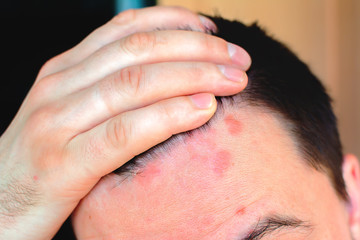 Man shows red psoriasis on his forehead