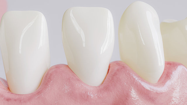 Tooth with caries attack in closeup - 3D Rendering