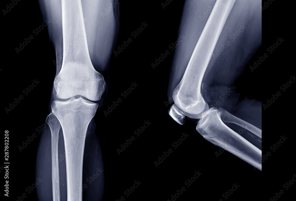 Poster x-ray image of right knee joint ap view and lateral view. knee x-ray.