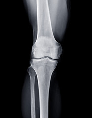 X-ray image of Right knee joint  AP view. knee x-r