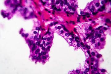 Benign prostatic hyperplasia, light micrograph, photo under microscope. High magnification showing papillary projections inside the lumen of the glands