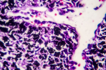 Histopathology of smoker's lung. Light micrograph showing accumulation of carbon particles in lung tissue