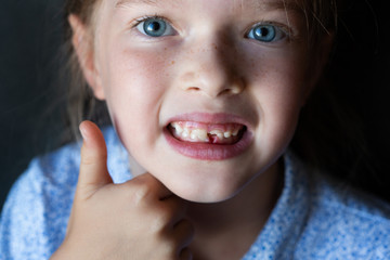 a little happy girl lost her front tooth, holds it in her hand, the gum is bleeding. Childhood healthcare concept.