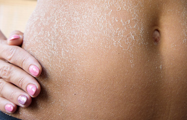 Close up of female belly skin peeling after sunburn at on summertime. - obrazy, fototapety, plakaty