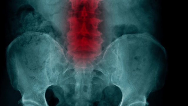 l-spine degenerative change with red hight light 