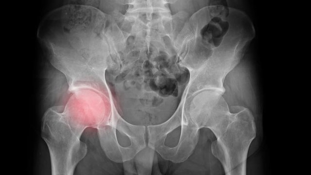hip degenerative change x-ray footage with red hight light, hip avascular necrosis 
