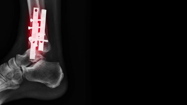 x-ray footage fracture at tibia bone with internal fixation 