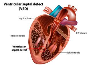 Ventricular septal defect (VSD).Congenital heart defect
