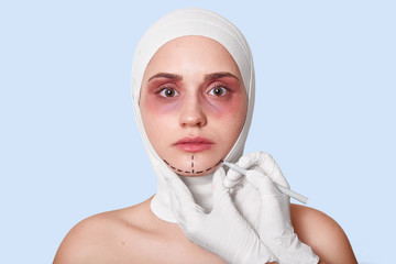 Medicine, surgery and disease concept. Young woman being in private clinic, having anti aging procedures, head wrapped with bandages after operation and bruises under eyes. Plastic surgery concept.