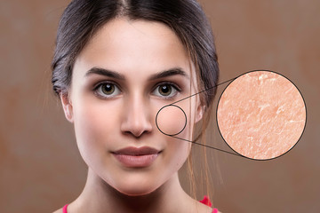 A young brunette woman is seen close up, a magnified circle shows macro skin details, dry and flaky...