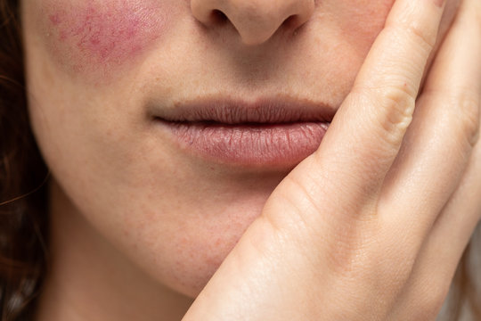 A close up view on a caucasian woman resting her chin on hand, with visible cracked lips and rosacea, in need of moisturization and dermatologist.