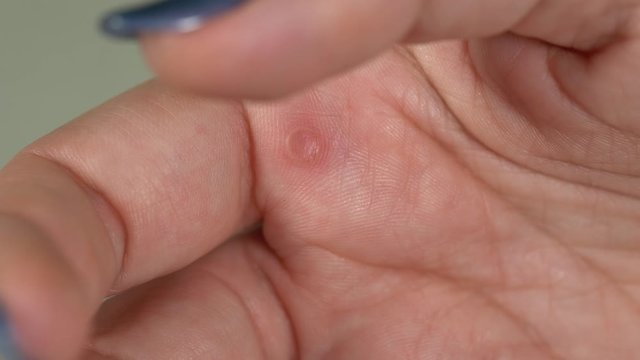 Closeup macro view of one small red callus on skin of hand of palm of white woman. Real time 4k video footage.