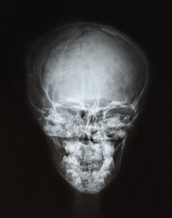 X-ray film of the child's skull.