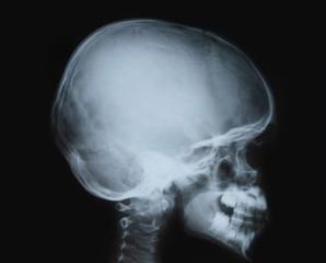X-ray film of the head, child's skull.