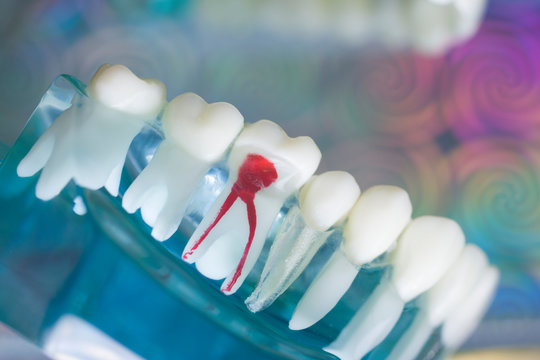 Dentist tooth decay dental model