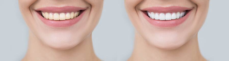 Collage female smile before and after teeth whitening. Advertising procedure whitening smile